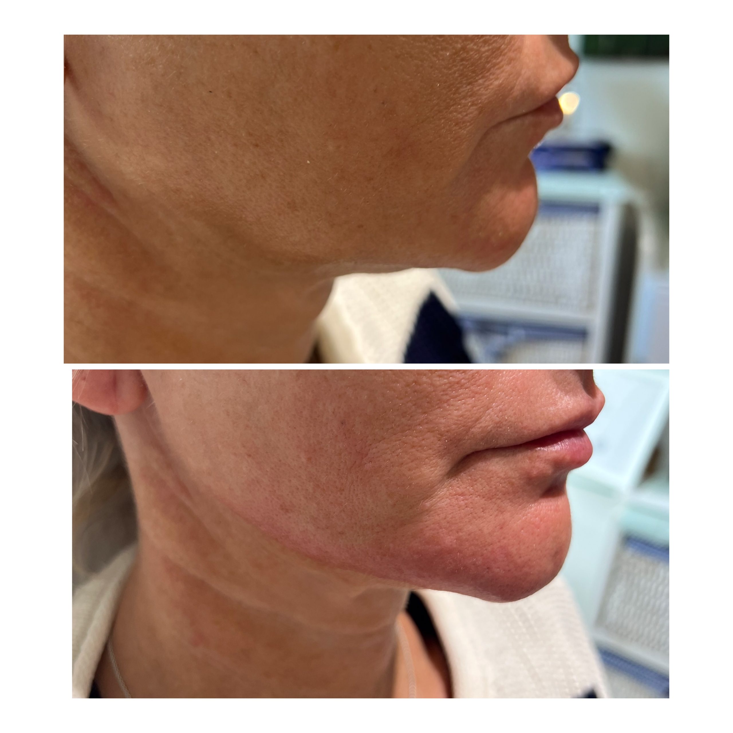 IMG_3228 Jawline Dermal Filler Oxfordshire