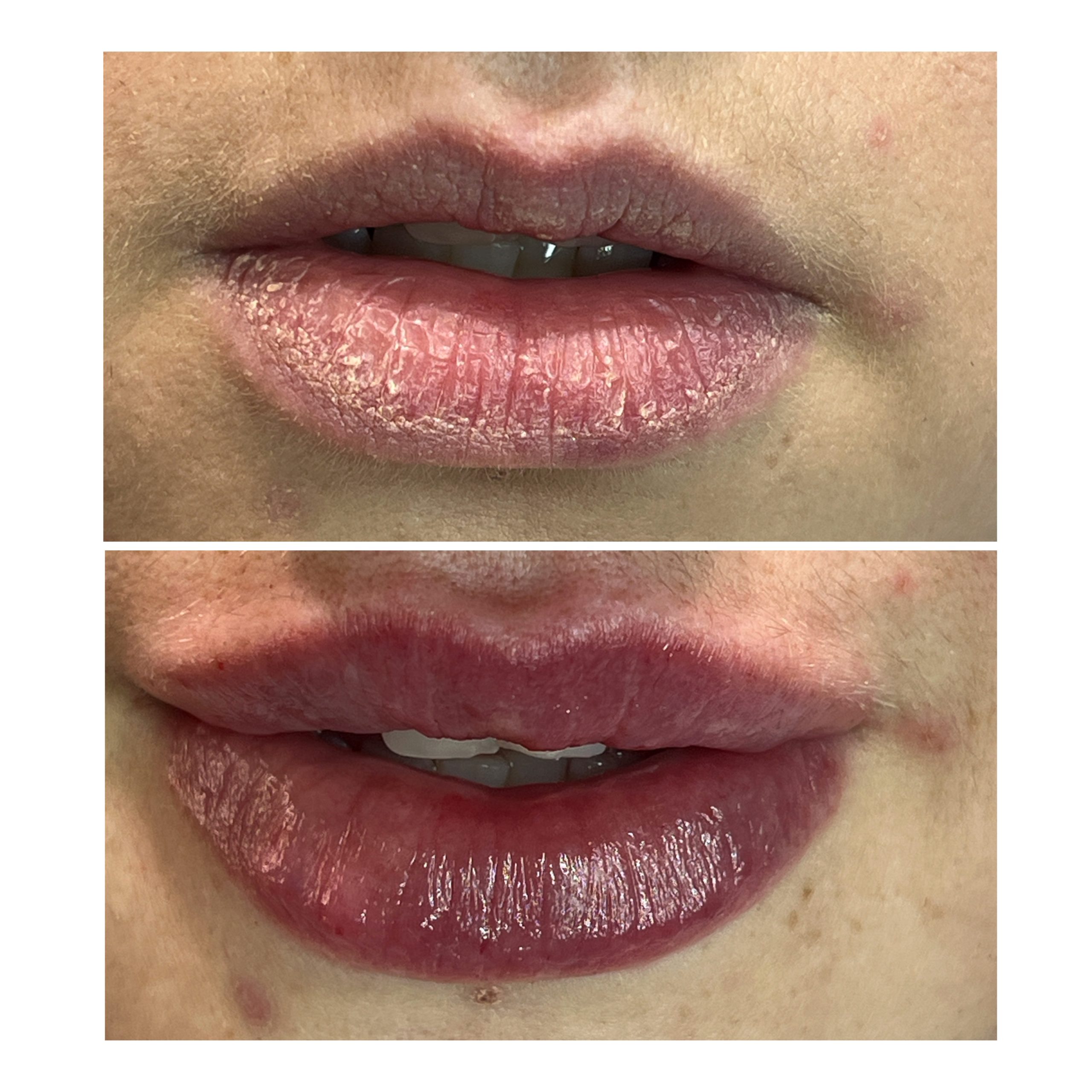 Lip Fillers in Witney Lip Fillers in Witney