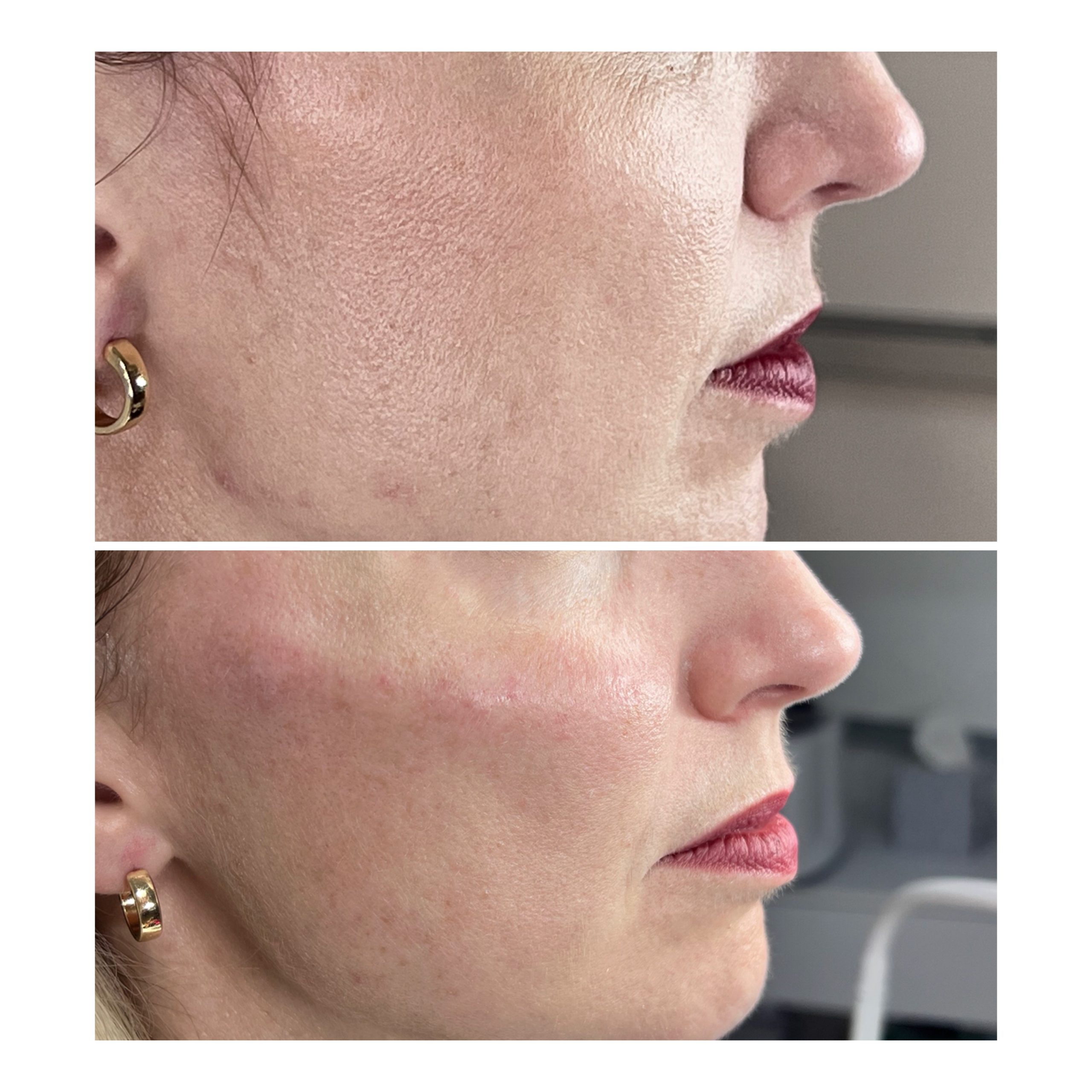 IMG_3230 Cheek Dermal Filler