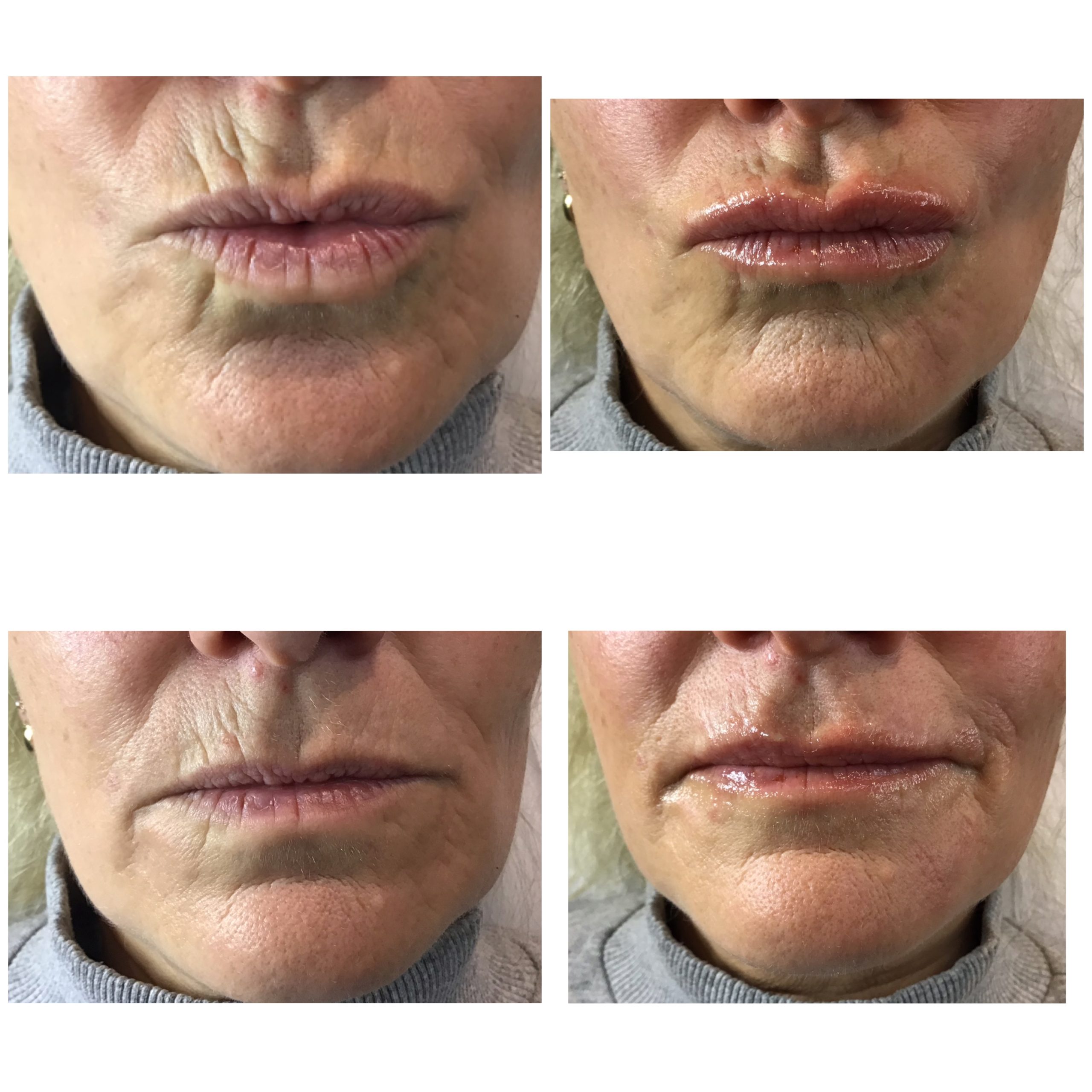 Perioral Fillers Perioral Fillers
