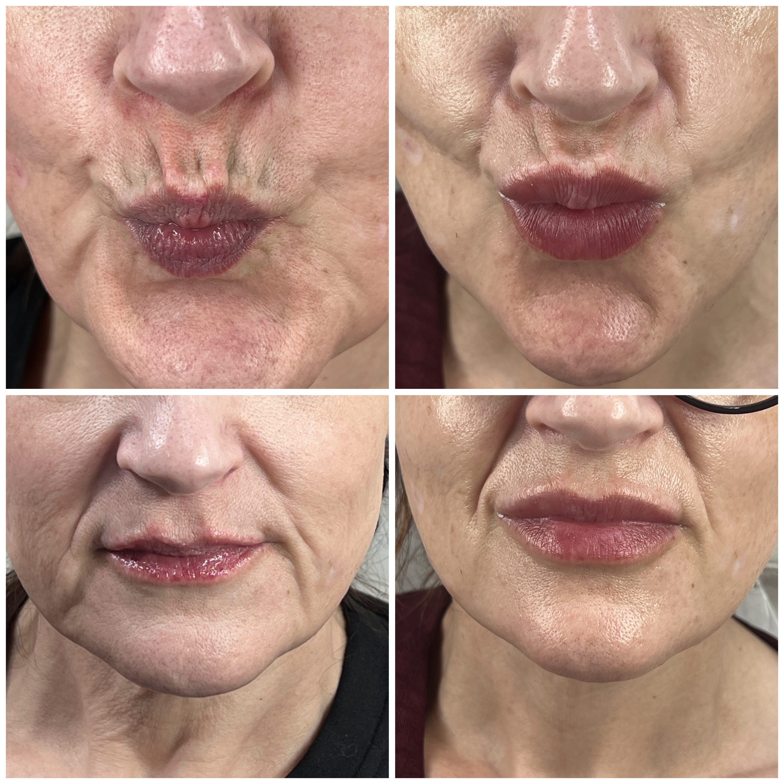 Lower Face Anti-Wrinkle Treatment Lower Face Anti-Wrinkle Treatment
